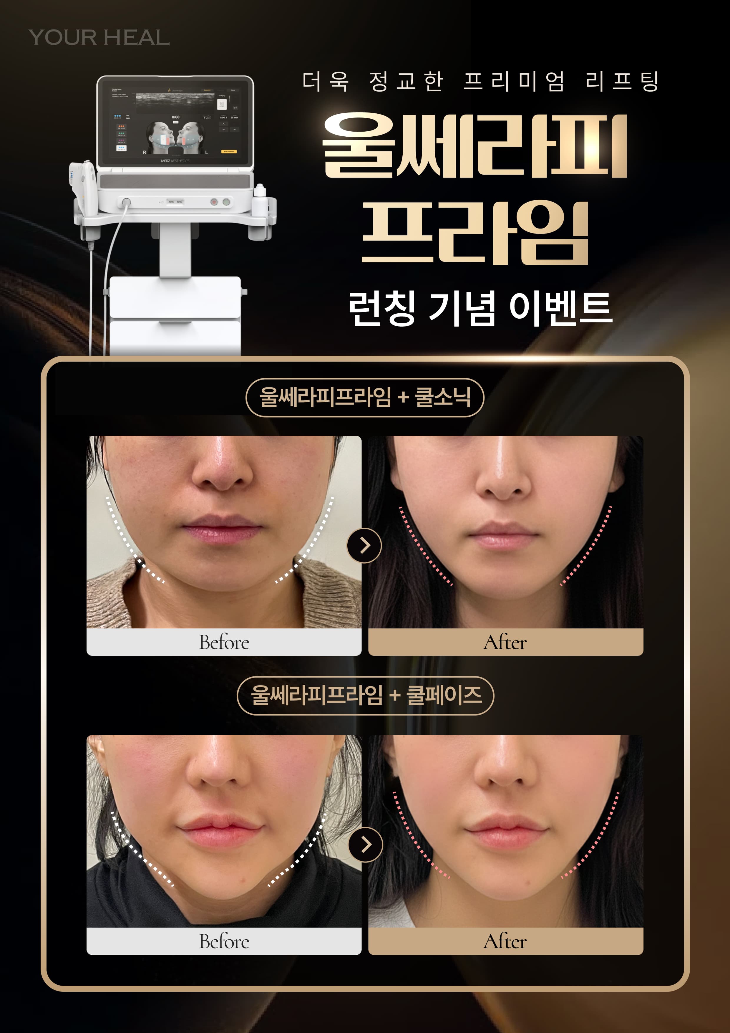 ✨울쎄라피프라임 런칭 특가✨